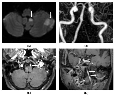 Diagnostics | Free Full-Text | Acute Distal Vertebral Artery Occlusion ...