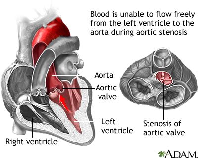 Aortic Valve Stenosis: Symptoms- Causes And Treatments.