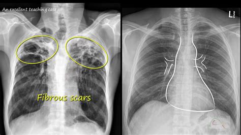 Tuberculosis Lung X Ray