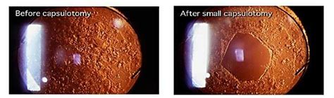 Yag Capsulotomy - Sydney Retina Clinic