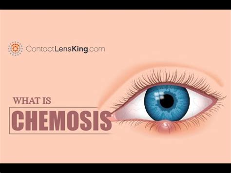 What is Chemosis? Eye Inflammation Causes and Symptoms - YouTube