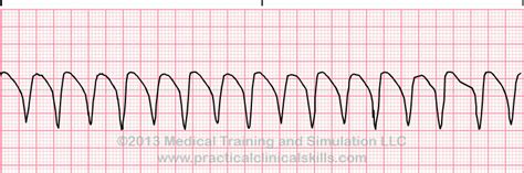 Ventricular Tachycardia