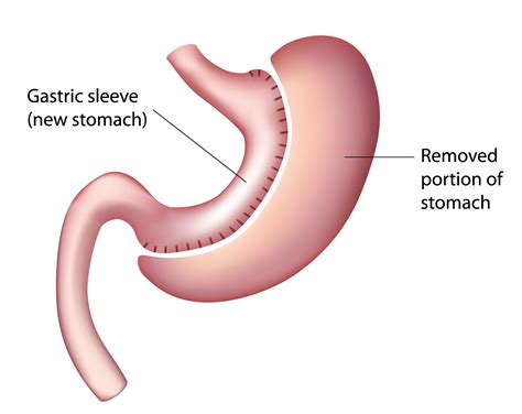 Gastric Sleeve Surgery – MU Health Care – Columbia, MO