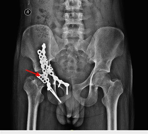 X-ray pelvis shows the right acetabulum fixed internally with plates ...