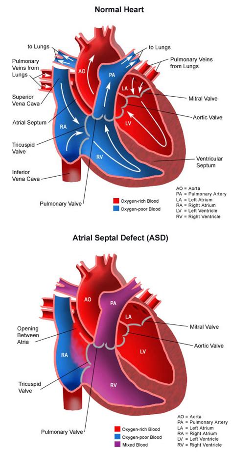 Atrial Septal Defect - Children's Health Orange County