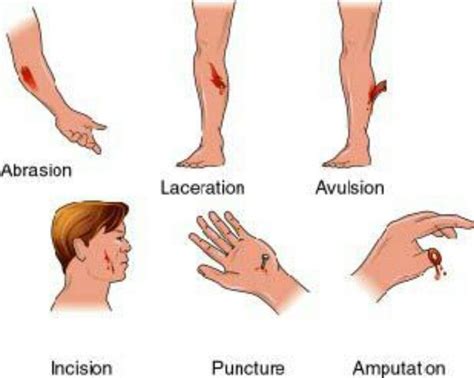 type of wounds. | Wounds nursing, Nursing school survival, Nursing notes