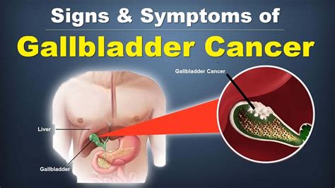 Signs & Symptoms of Gallbladder Cancer by Gastroclinix - YouTube