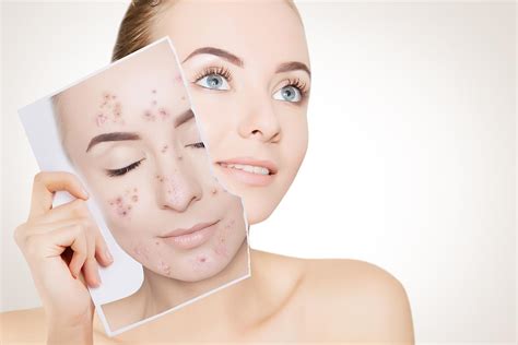 How Does IPL Treatment for Acne Really Work?