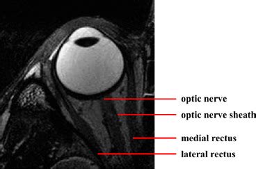 Optic Nerve MRI Anatomy | Radiology Anatomy Images