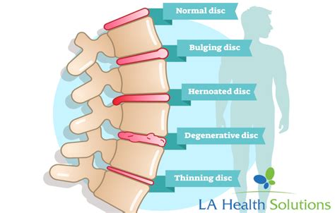 What Is Degenerative Disc Disease? | LA Health Solutions