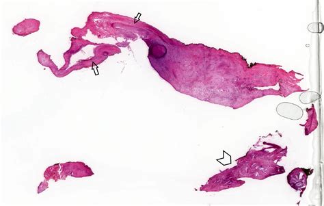 Dentigerous Cyst Histology