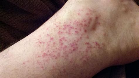 Diabetic rash on legs pictures | Symptoms and pictures