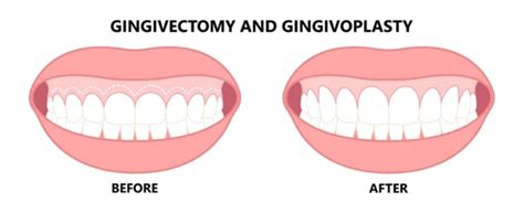 Gingivectomy / Gingivoplasty in San Jose, CA [Highly Rated Dentist]Dr ...