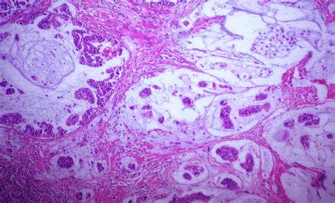 Mucinous adenocarcinoma, moderately differentiated (H&EX200 ...