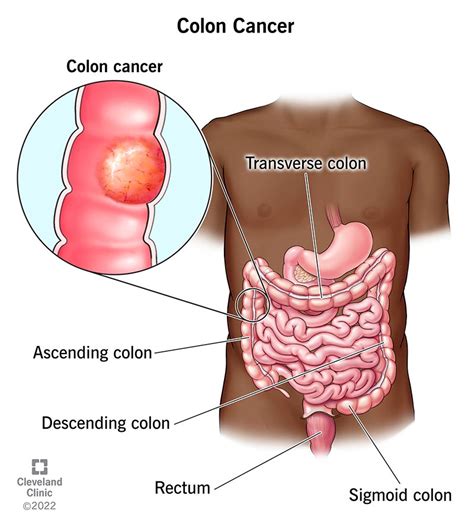 Colon Cancer: Symptoms, Stages & Treatment