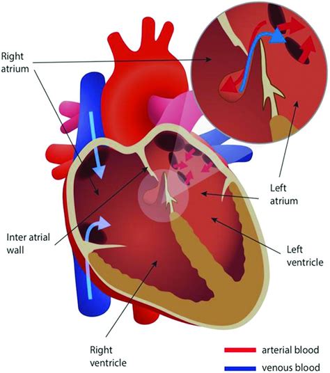 Patent foramen ovale | Practical Neurology