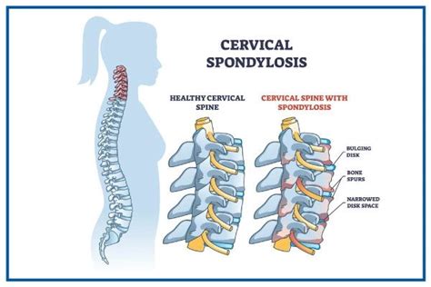 Cervical Spondylosis