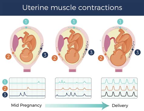 Uterine contractions causes, uterine contractions not pregnant & during ...