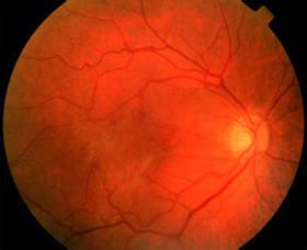 Epiretinal Membrane (Macular Pucker) Surgery & Recovery | Eye Center of ...