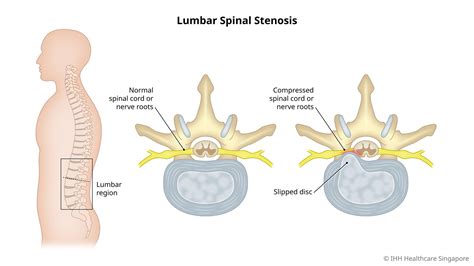 Lumbar Spinal Stenosis - Symptoms & Causes | Gleneagles Hospital