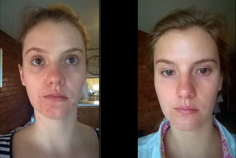 Azelaic acid – clear after 10+yrs of acne – Prescription acne ...