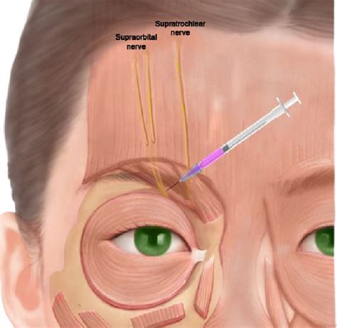 Supraorbital Nerve Block - NASHVILLE NEUROSCIENCE GROUP