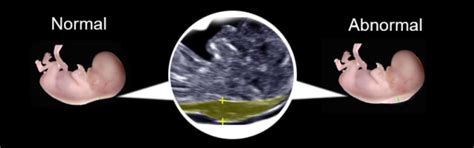 Nuchal Translucency Scan | Fatima Gani