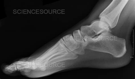 Normal foot, X-ray | Stock Image - Science Source Images