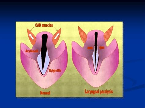 Laryngeal diseases