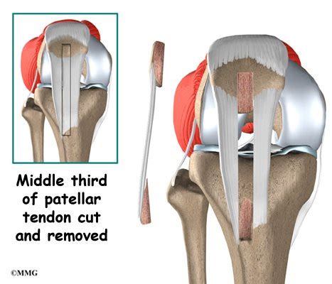 Hip muscle and tendon pain jogging, hip weight loss exercises ...