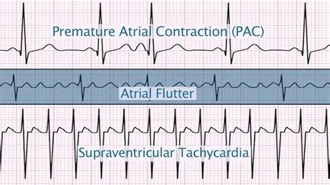 "Supraventricular Arrhythmias" by Christine LaGrasta, MS, RN, CPNP PC ...