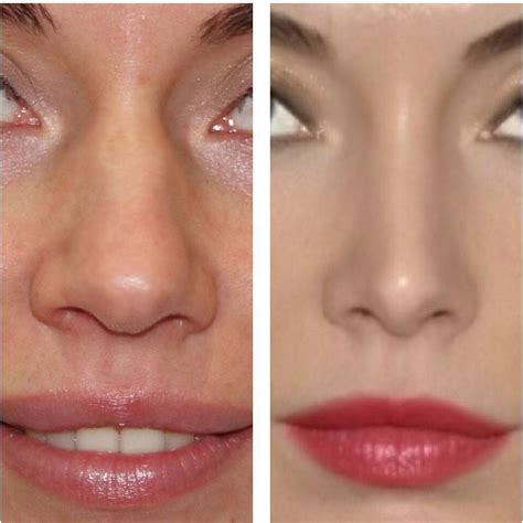 Nose Job To Fix Bulbous Nose » Rhinoplasty: Cost, Pics, Reviews, Q&A ...