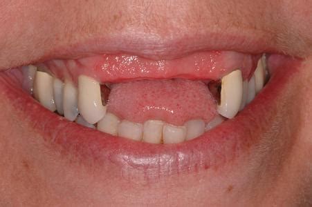 Dr. James S. Kim, DDS. SC's Smile Gallery | Partial Denture/Flipper