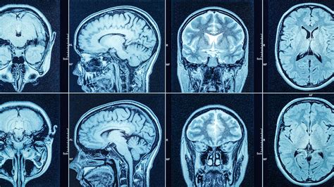 Cat Scan Brain Tumor