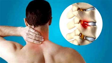 Cervical Spondylosis: What are its Symptoms & Treatment? – Arun Bhanot