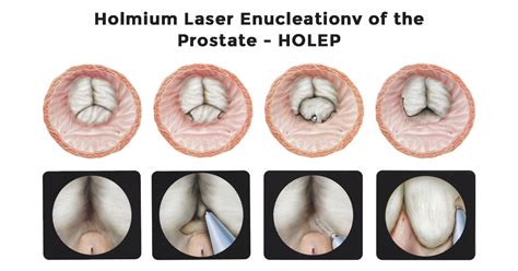 Holmium Laser Enucleation of the Prostate (HoLEP) - Gabani Kidney ...