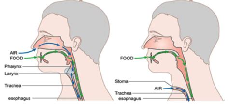 Electrolarynx — Karen Panetta