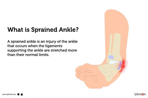 Sprained Ankle: Causes, Symptoms, Treatment and Cost