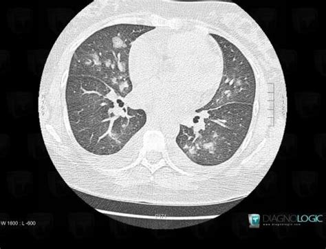 Radiology case : Pulmonary edema (CT) - Diagnologic