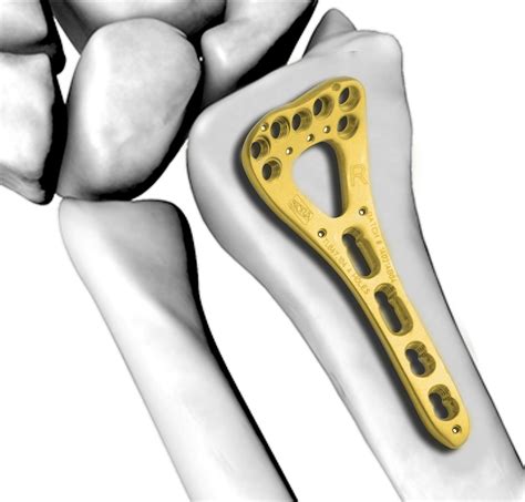 Orthopedic Implants Manufacturer: Adding Gold to Titanium Enhances ...