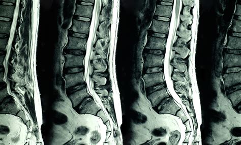 Should You Get an MRI for Your Back Pain - Holland Park Osteopaths