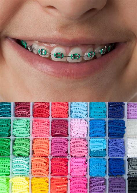 Coloured Braces - Quayside Orthodontics