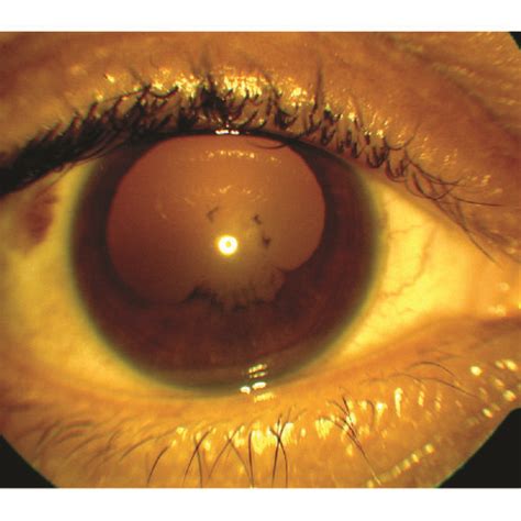 External photo of the right eye demonstrating posterior synechiae with ...