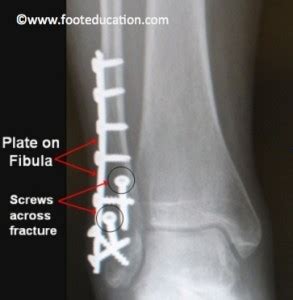 Ankle Fracture ORIF - FootEducation