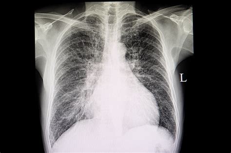 A Chest Xray Film Of A Patient With Congestive Heart Failure Stock ...