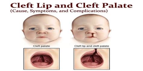 Cleft Lip and Cleft Palate (Cause, Symptoms, and Complications ...