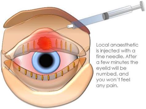 Eyelid Pimple Inside