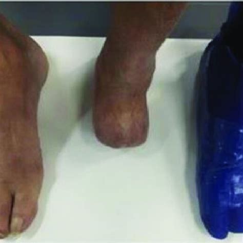 Photo of patient´s healthy foot, amputated foot, and final prosthesis ...