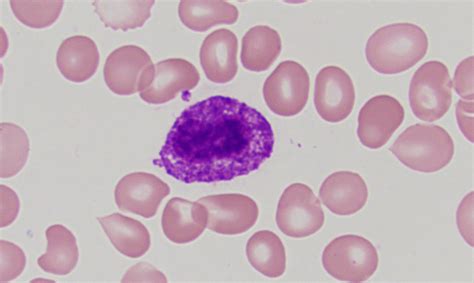 Pathology Outlines - Mast cells