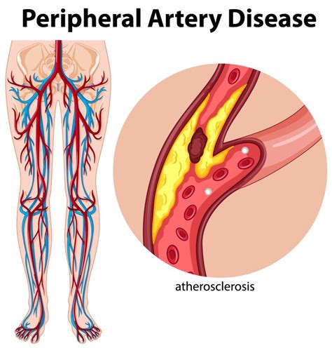 Peripheral Artery Disease – Symptoms, Causes, & Treatment